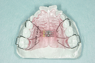 可撤（かてつ）式歯列拡大装置